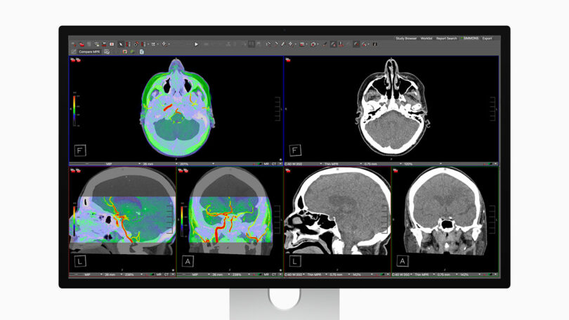 A computer monitor displays multiple brain scan images, including colored and grayscale cross-sectional views from different angles.